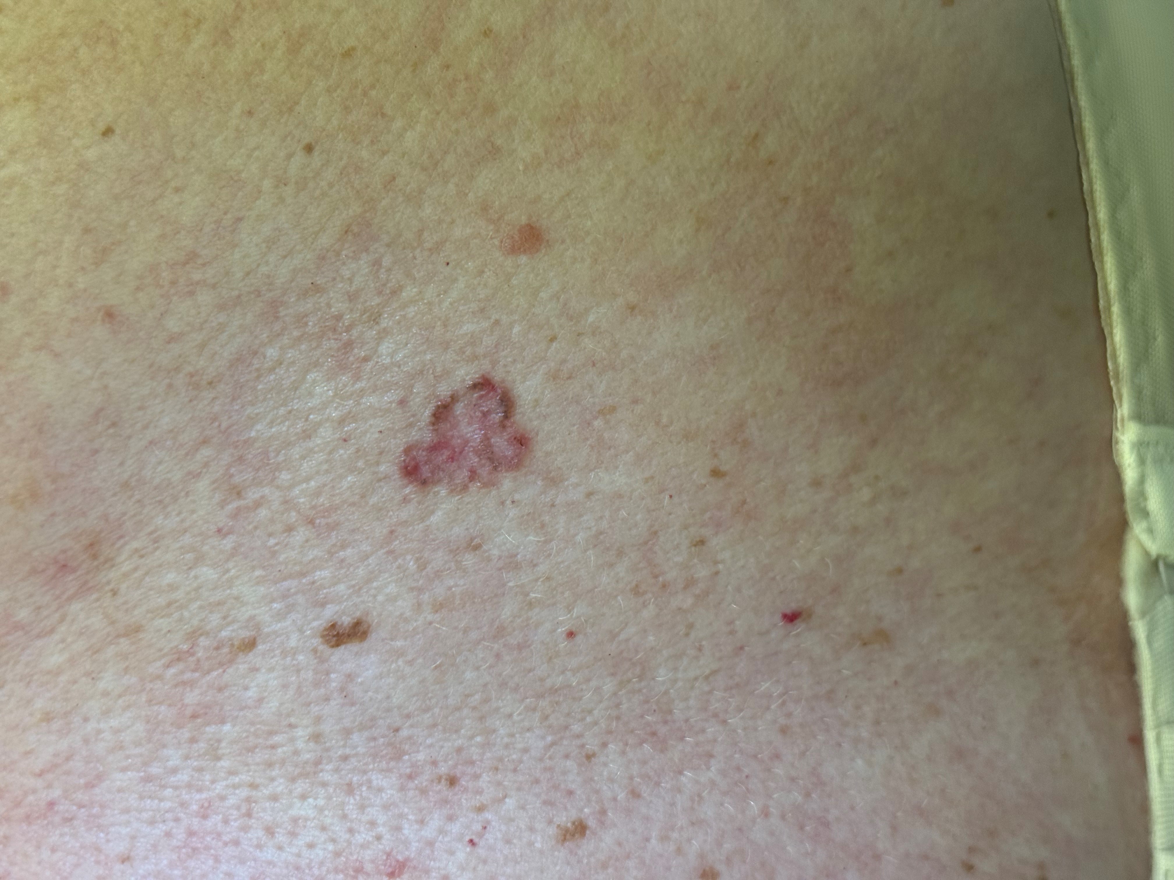 БКР, макроснимок и дерматоскопическое изображение.