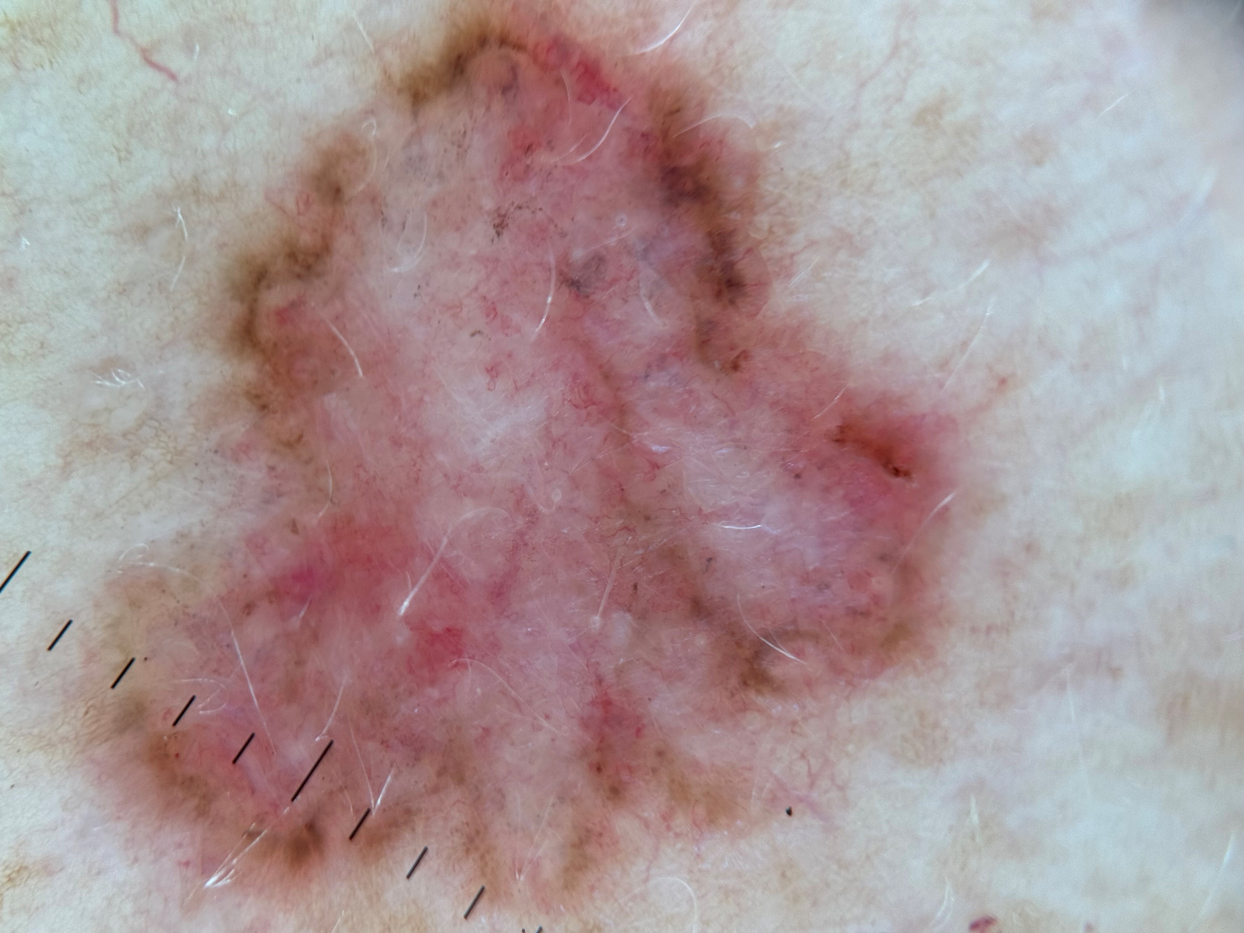 БКР, макроснимок и дерматоскопическое изображение.