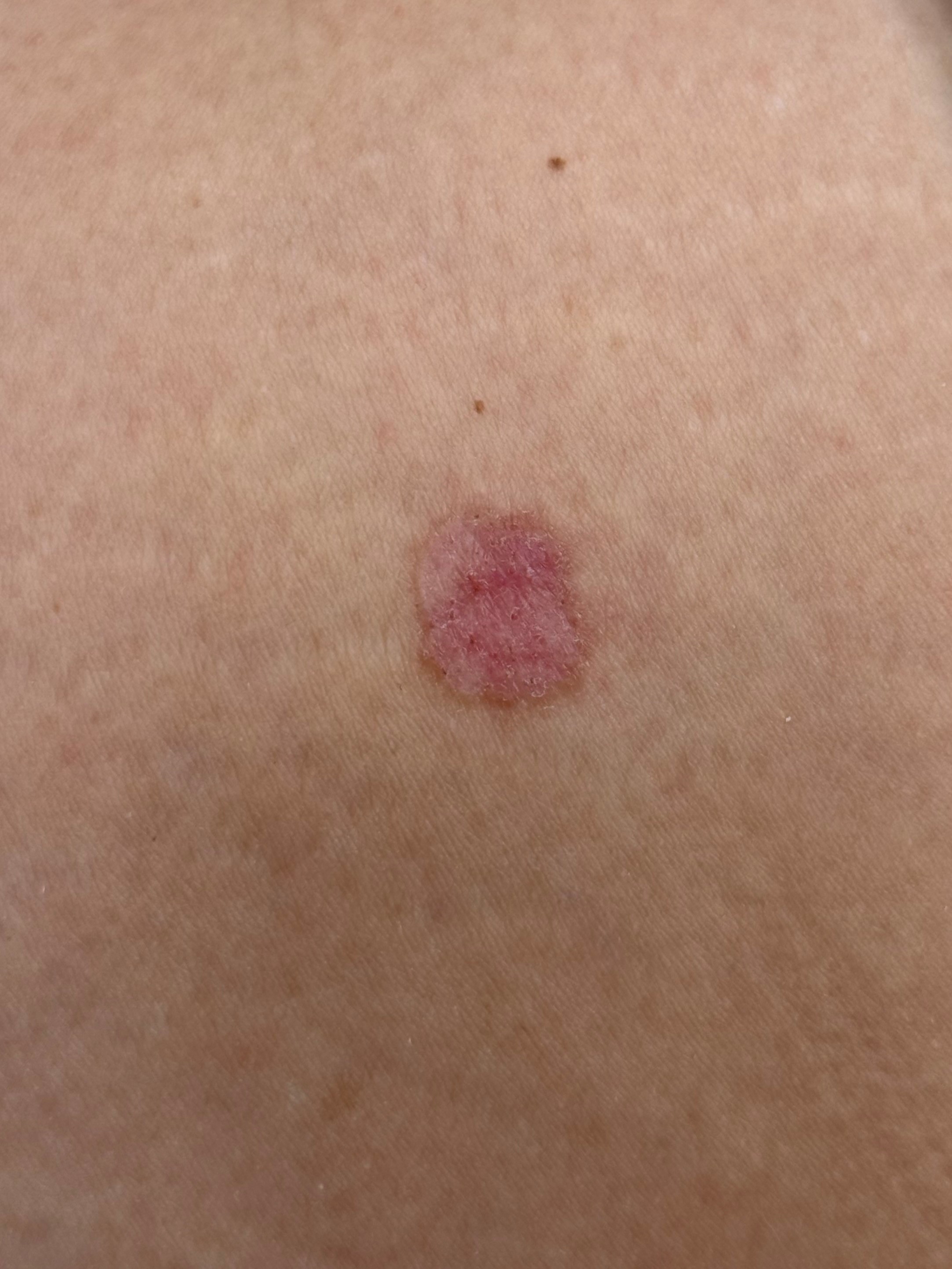 БКР, макроснимок и дерматоскопическое изображение.