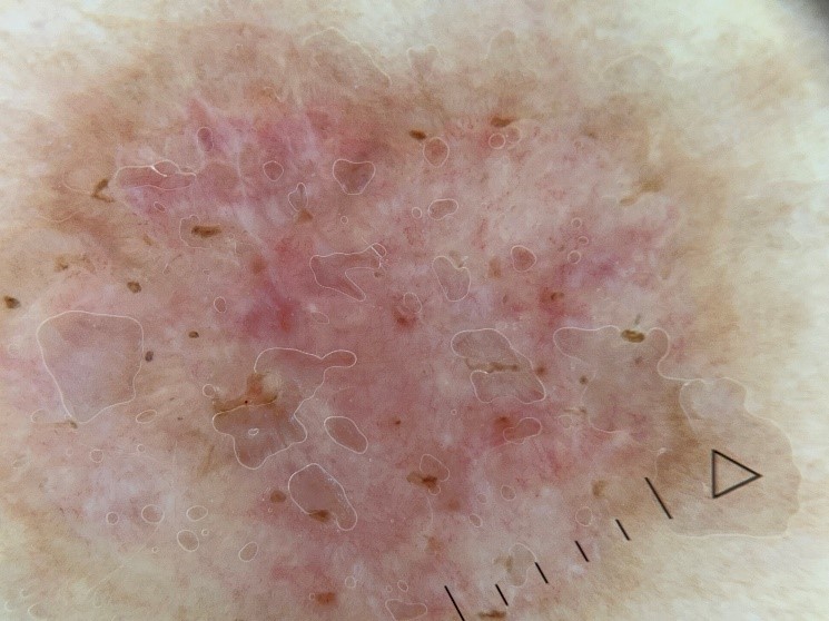 БКР, макроснимок и дерматоскопическое изображение.