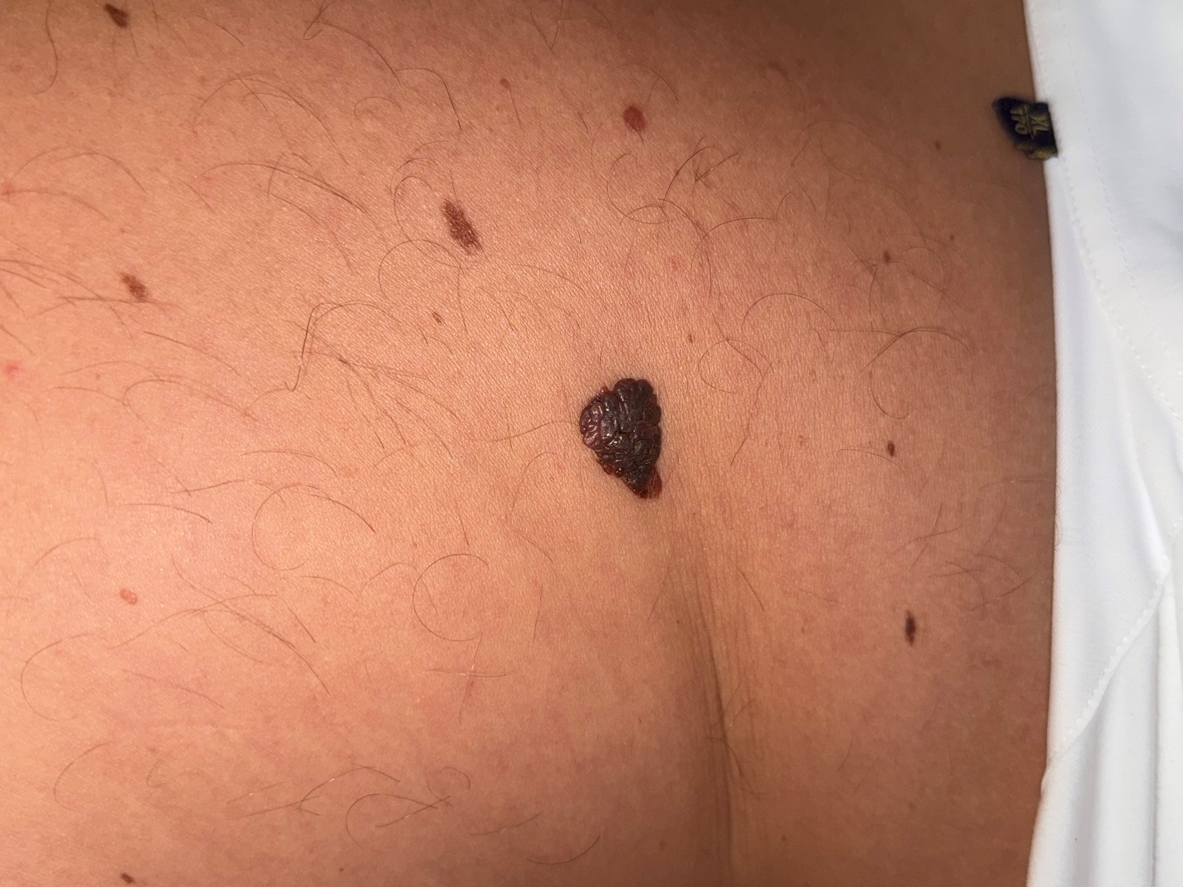 Меланома кожи поясничной области, макроснимок и дерматоскопическое изображение.