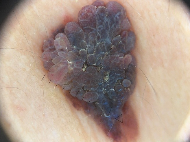 Меланома кожи поясничной области, макроснимок и дерматоскопическое изображение.