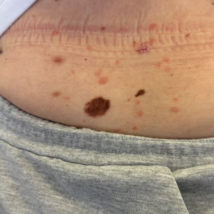 Меланома боковой поверхности туловища in situ, макроснимок и дерматоскопическое изображение