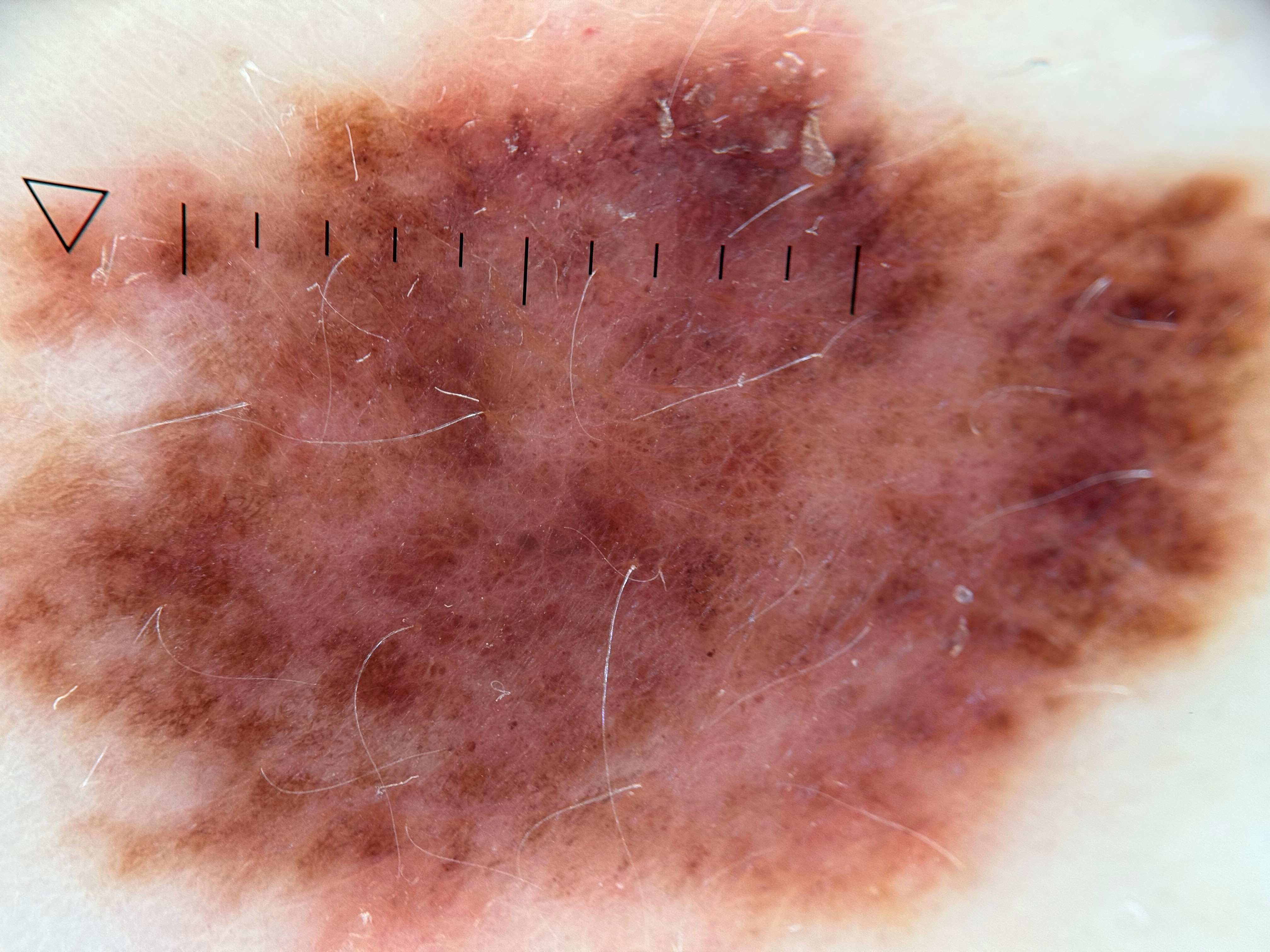 Меланома боковой поверхности туловища in situ, макроснимок и дерматоскопическое изображение