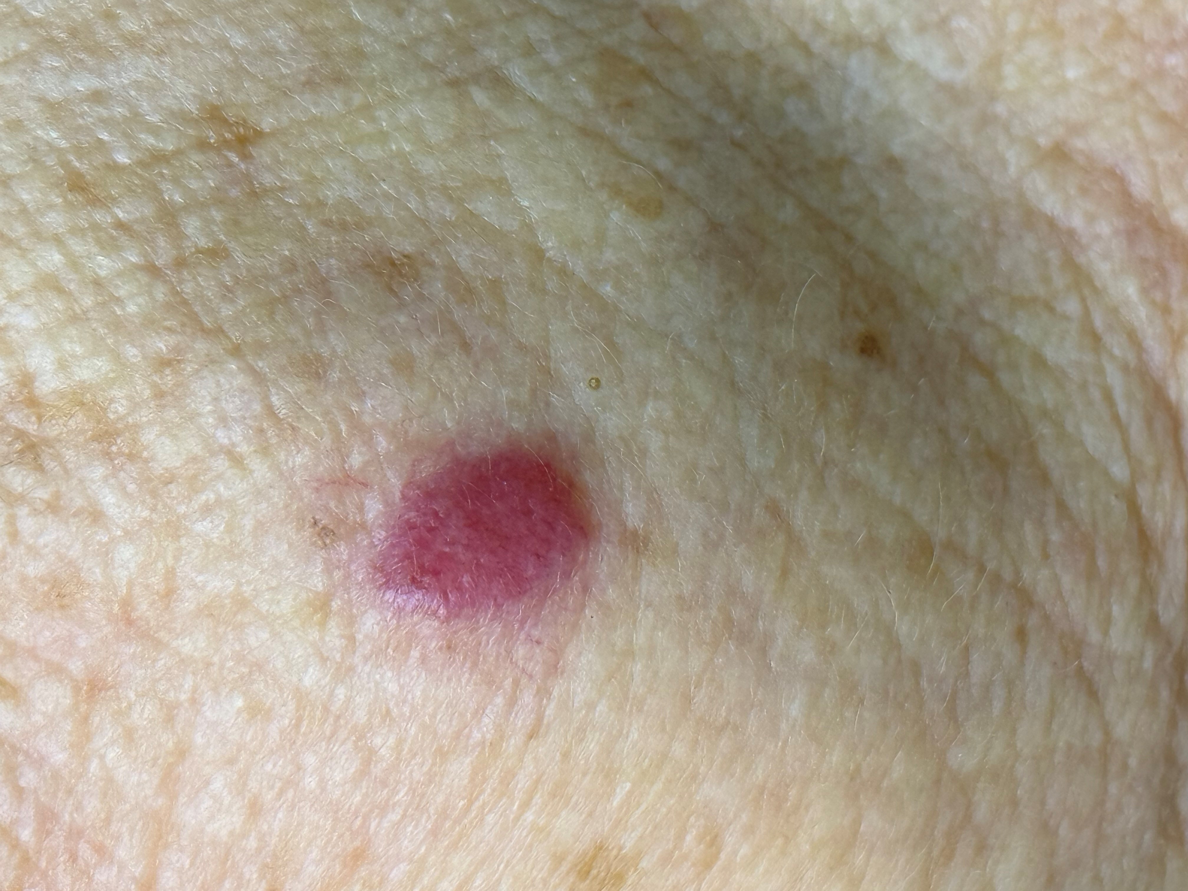 Карцинома Меркеля, макроснимок и дерматоскопическое изображение.