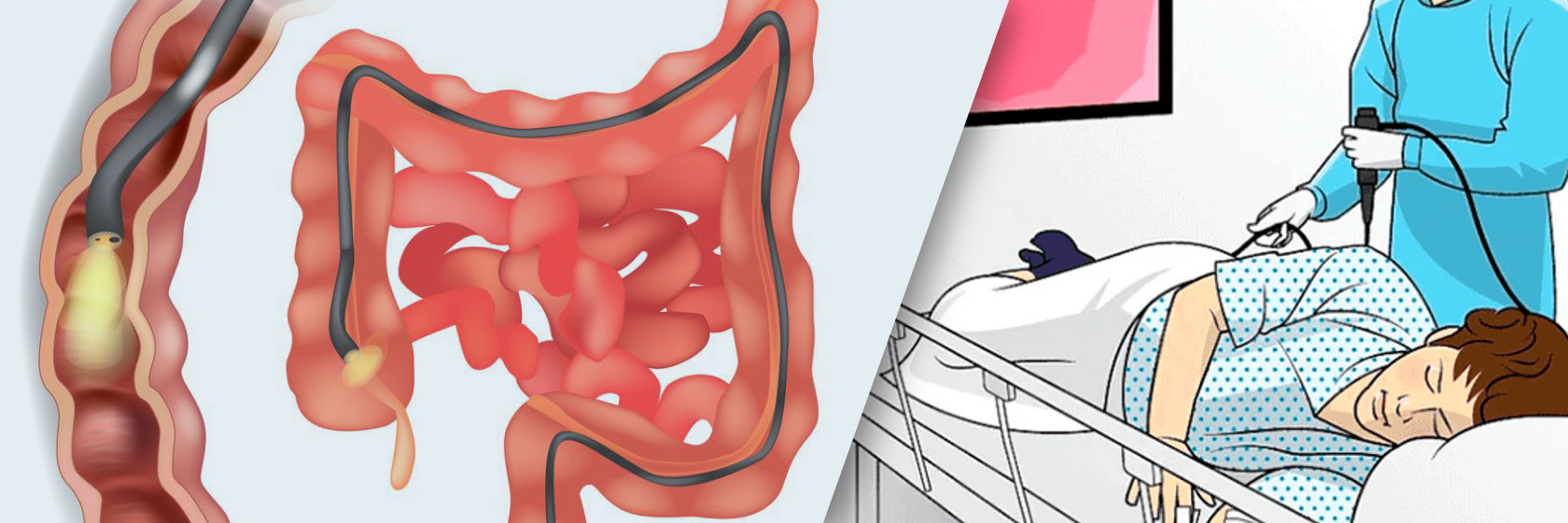 На рисунке – процедура колоноскопии и изображение кишечника